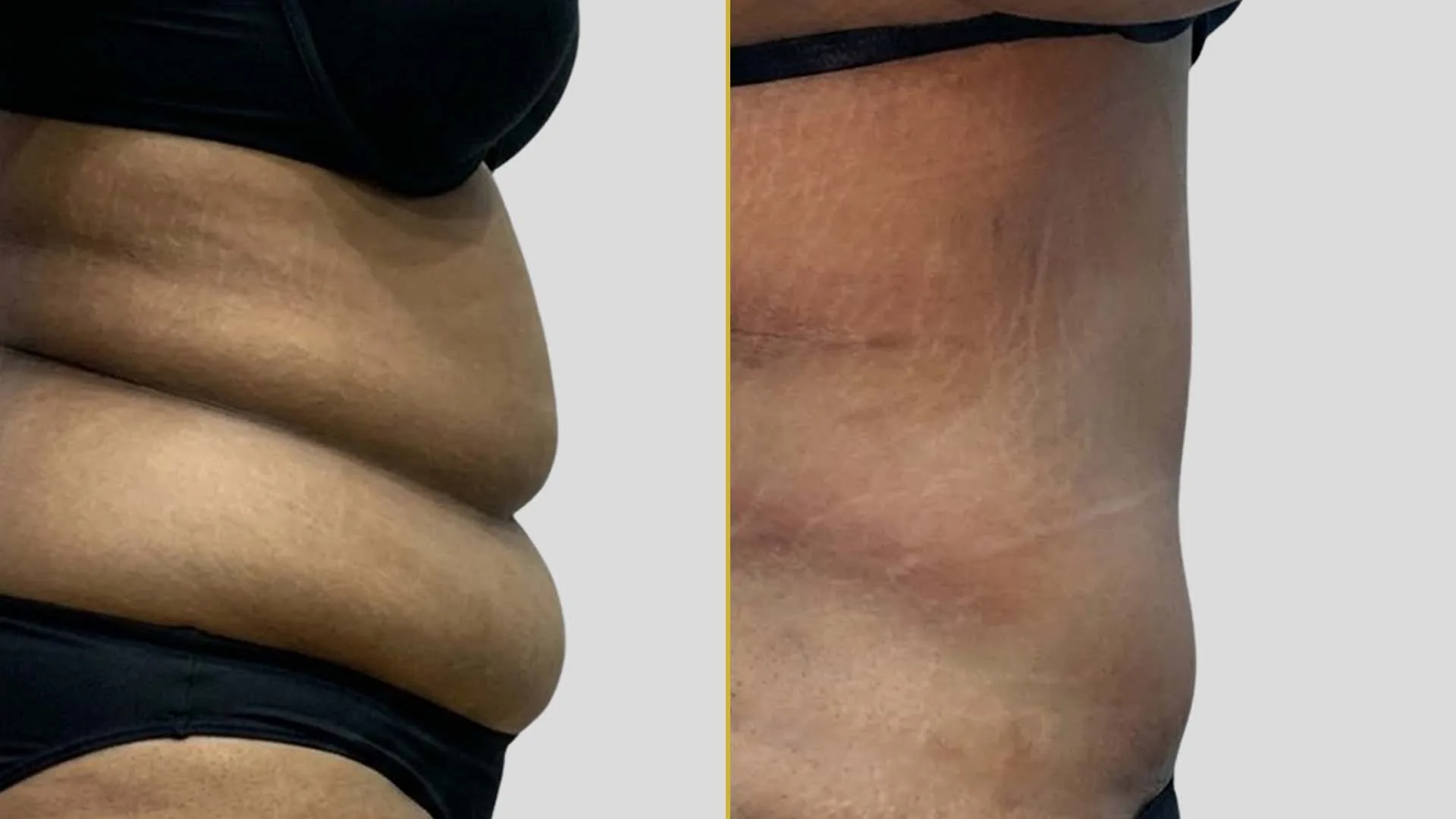 Tummy Tuck before and after result - The Hair and Shape Clinic, Mumbai