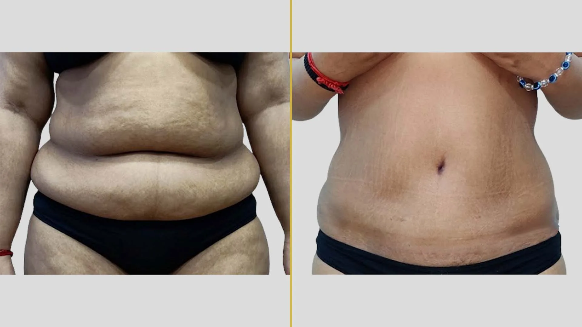 Tummy Tuck before and after result - The Hair and Shape Clinic, Mumbai