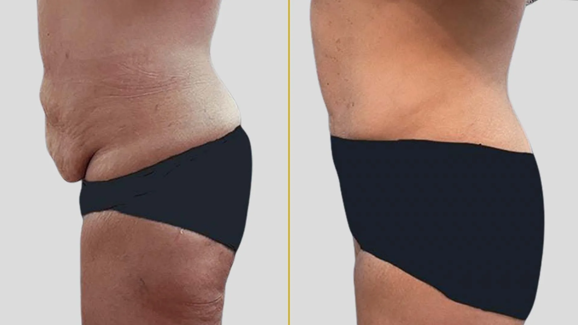Tummy Tuck before and after result - The Hair and Shape Clinic, Mumbai