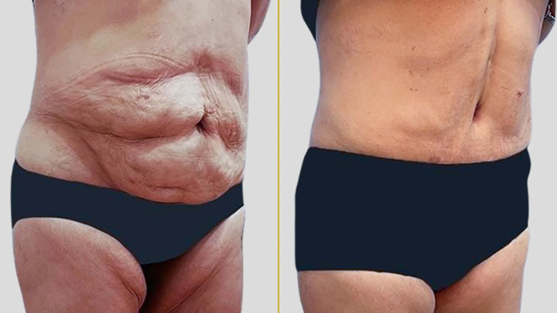 Tummy Tuck before and after result - The Hair and Shape Clinic, Mumbai