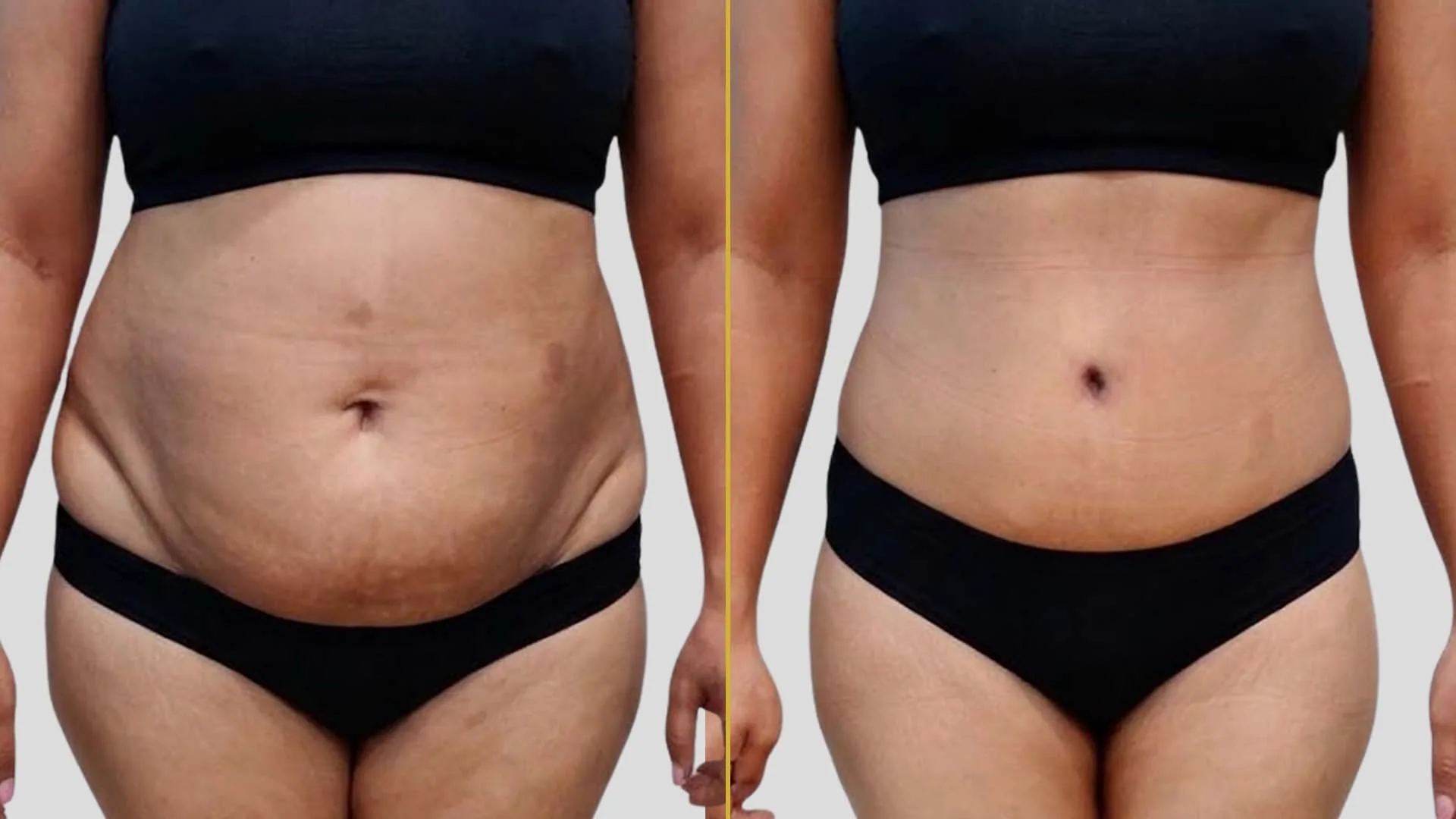 Tummy Tuck before and after result - The Hair and Shape Clinic, Mumbai