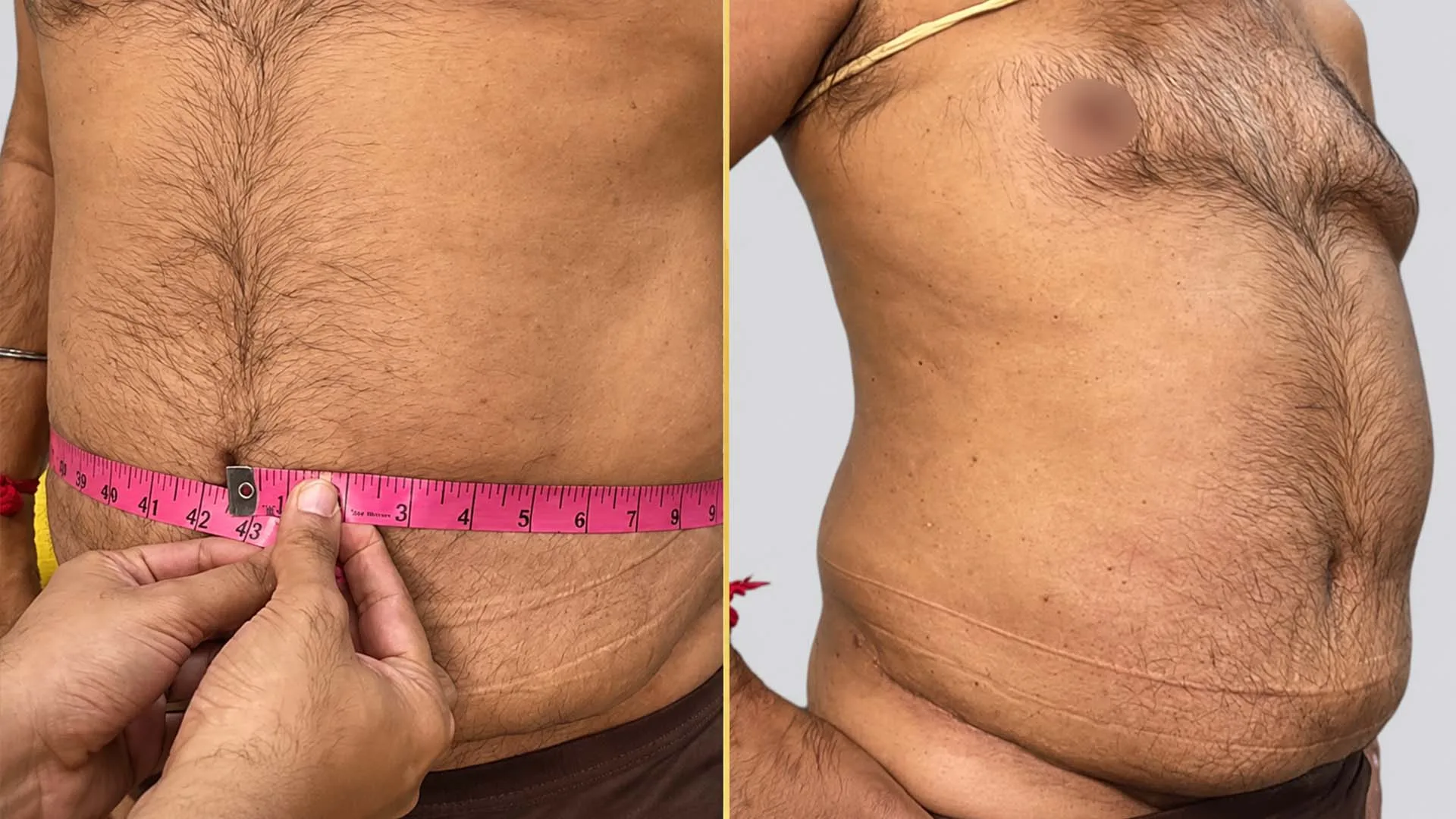 Tummy Tuck before and after result - The Hair and Shape Clinic, Mumbai