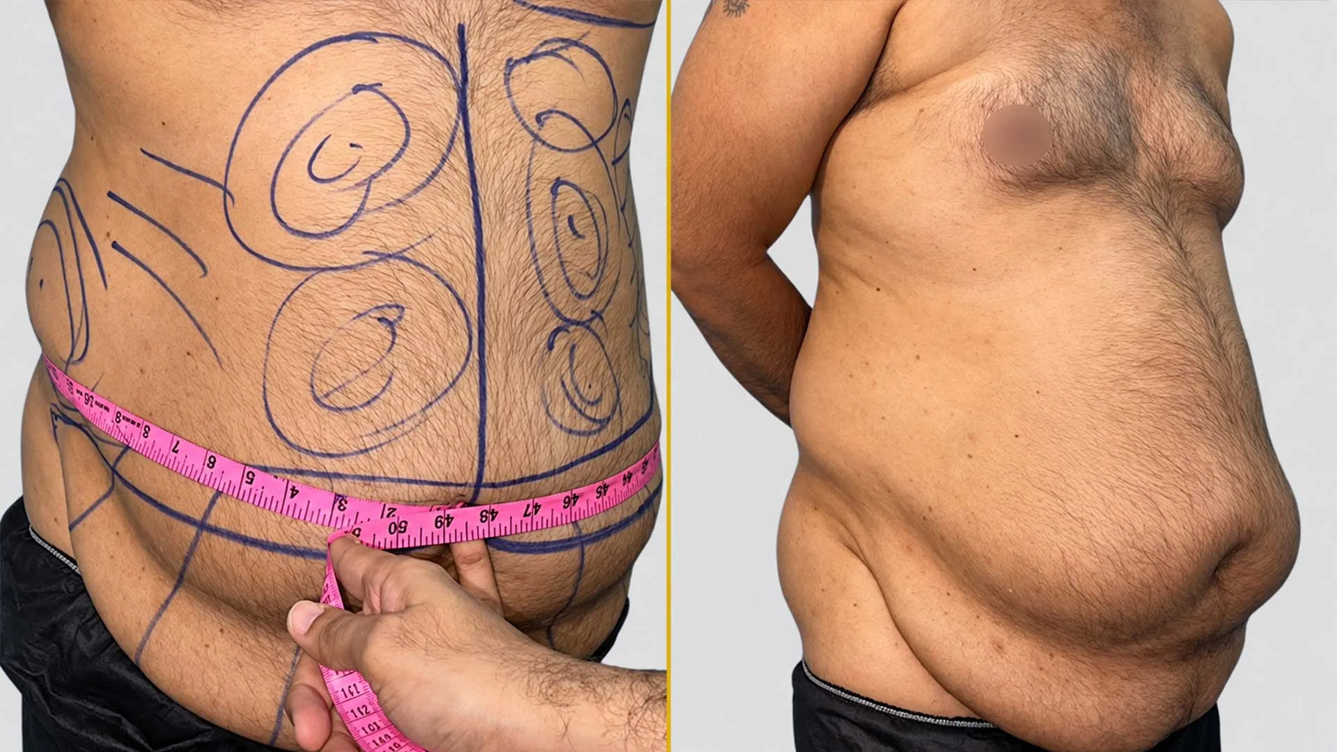 Tummy Tuck before and after result - The Hair and Shape Clinic, Mumbai