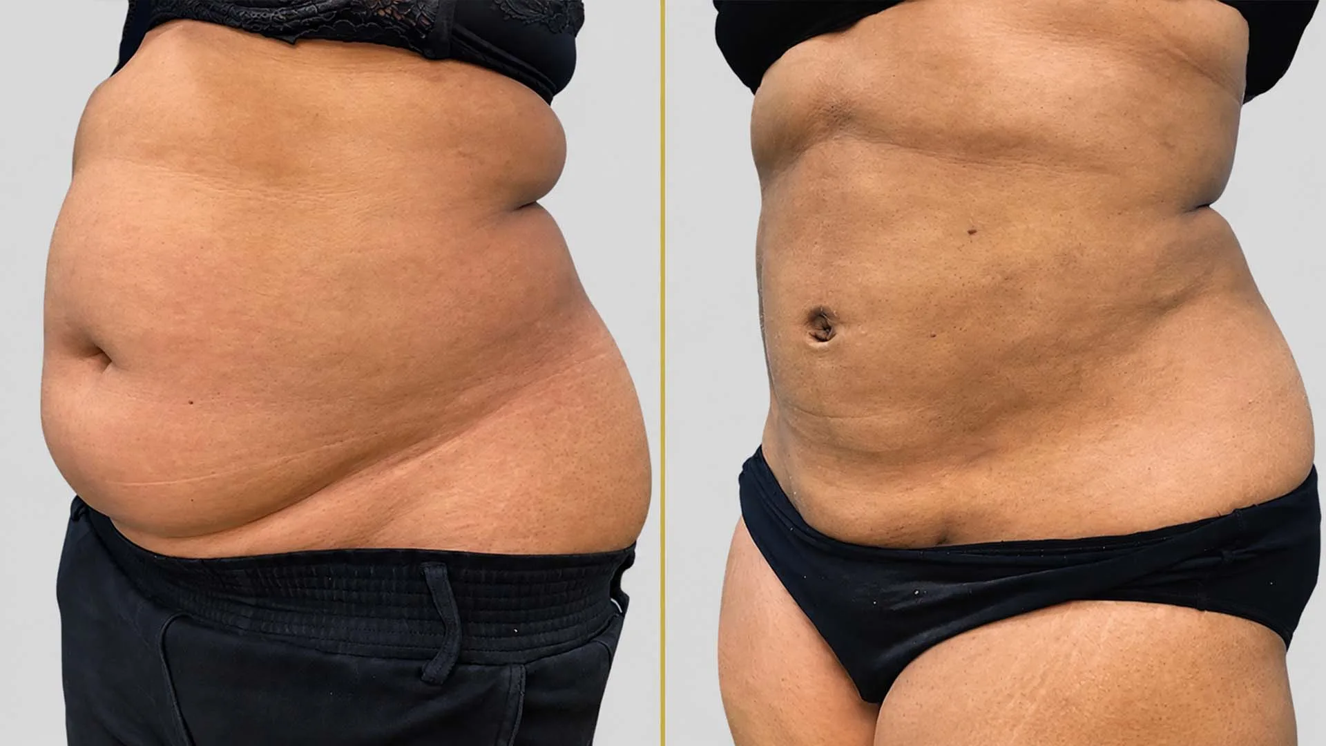 Tummy Tuck before and after result - The Hair and Shape Clinic, Mumbai