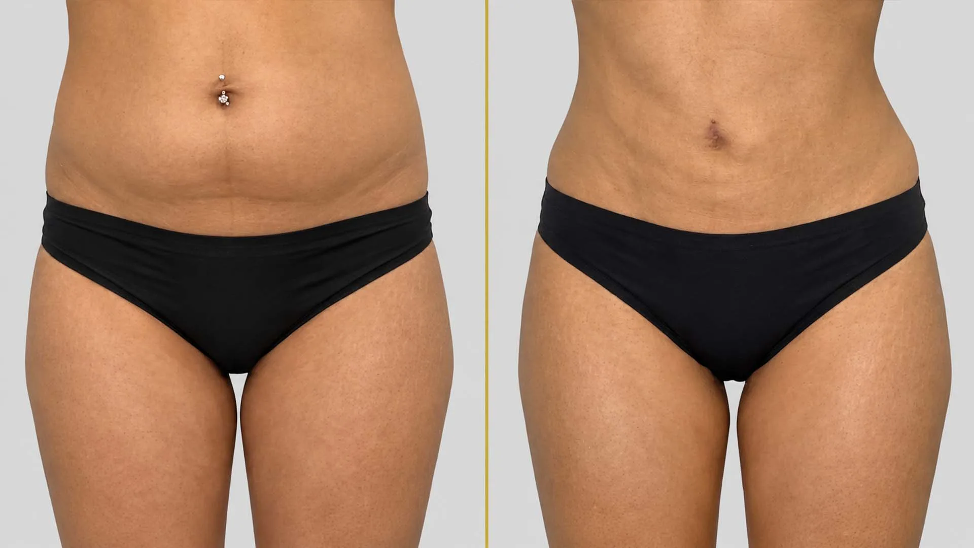 Tummy Tuck before and after result - The Hair and Shape Clinic, Mumbai