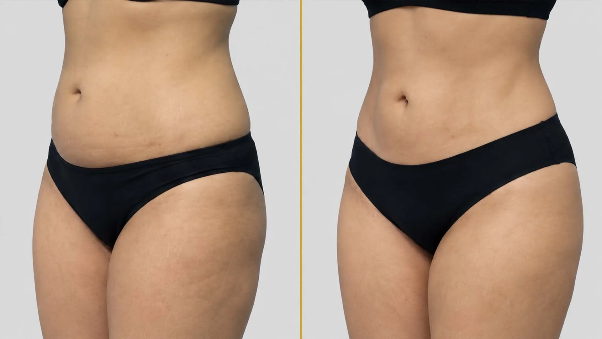 Tummy Tuck before and after result - The Hair and Shape Clinic, Mumbai