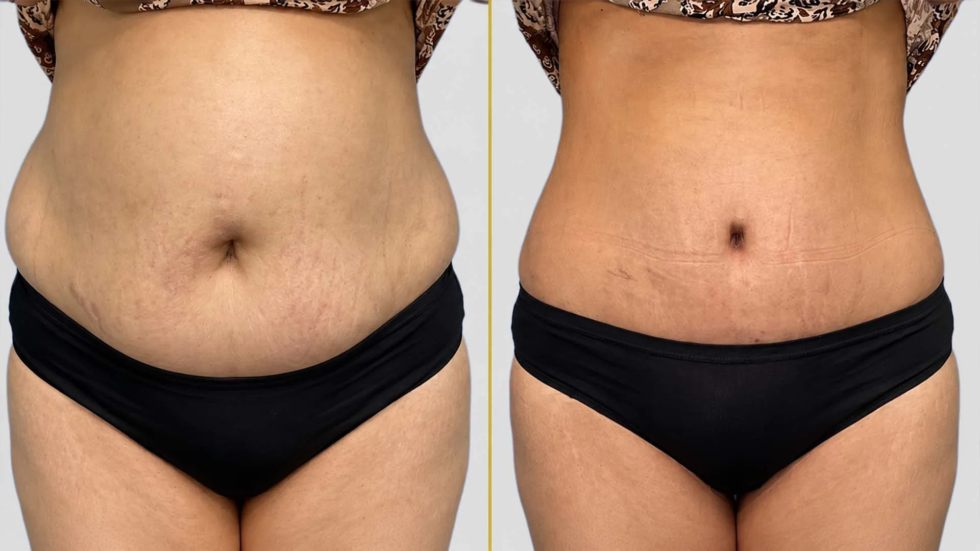 Tummy Tuck before and after result - The Hair and Shape Clinic, Mumbai