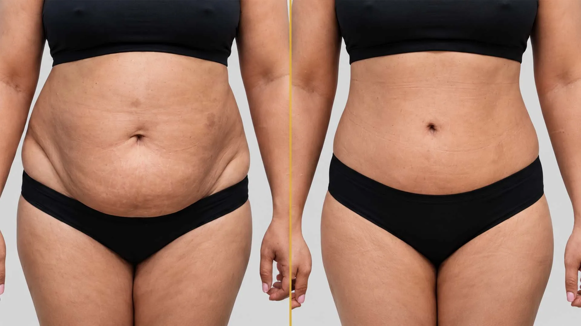 Tummy Tuck before and after result - The Hair and Shape Clinic, Mumbai