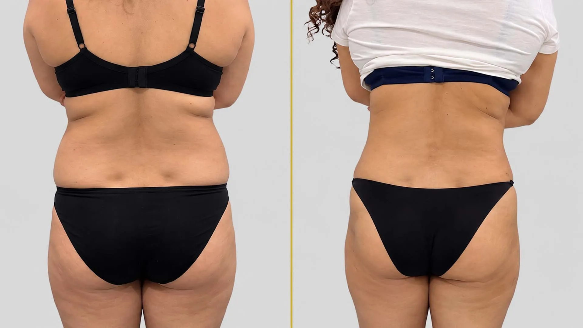 Tummy Tuck before and after result - The Hair and Shape Clinic, Mumbai