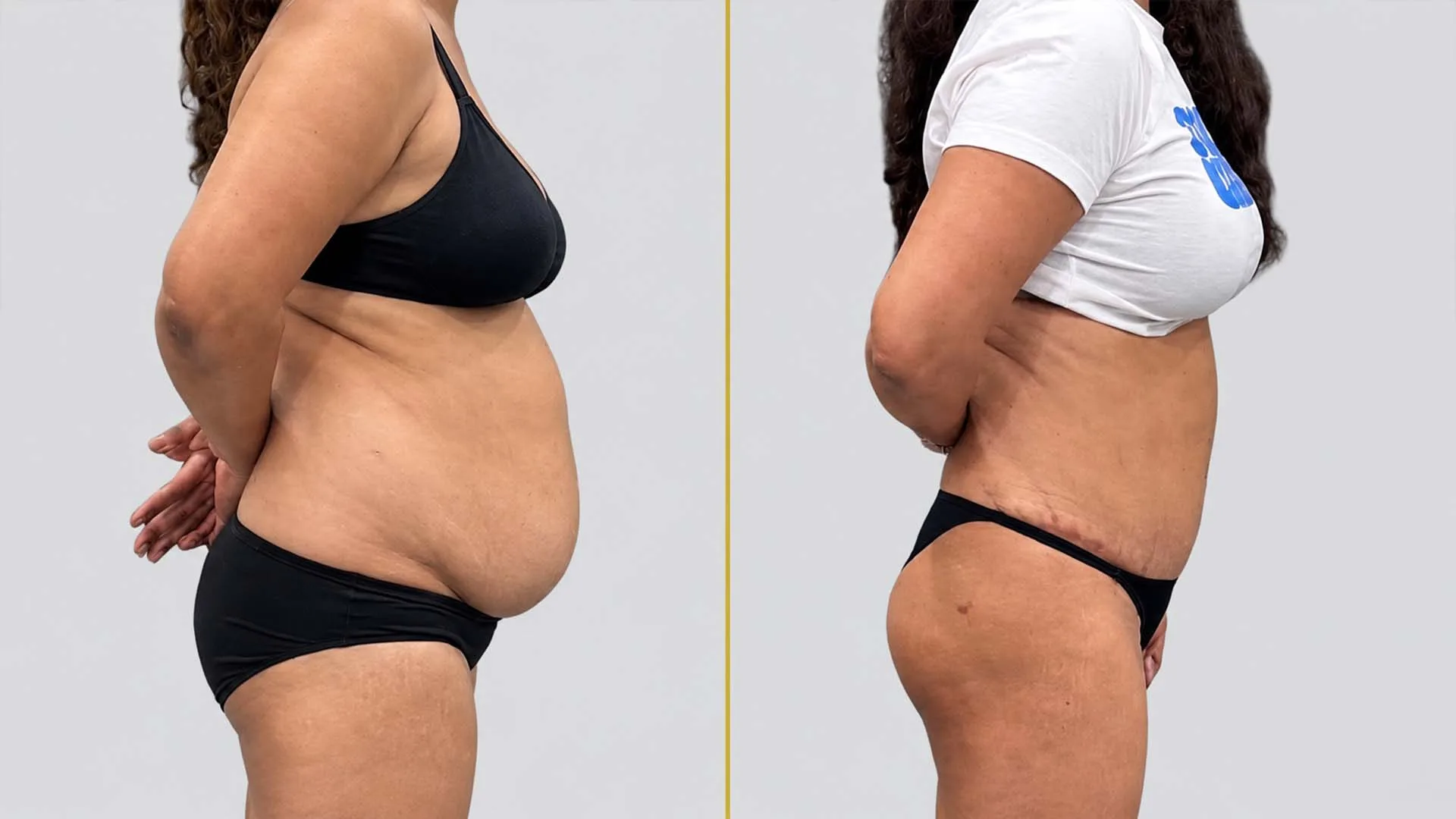 Tummy Tuck before and after result - The Hair and Shape Clinic, Mumbai