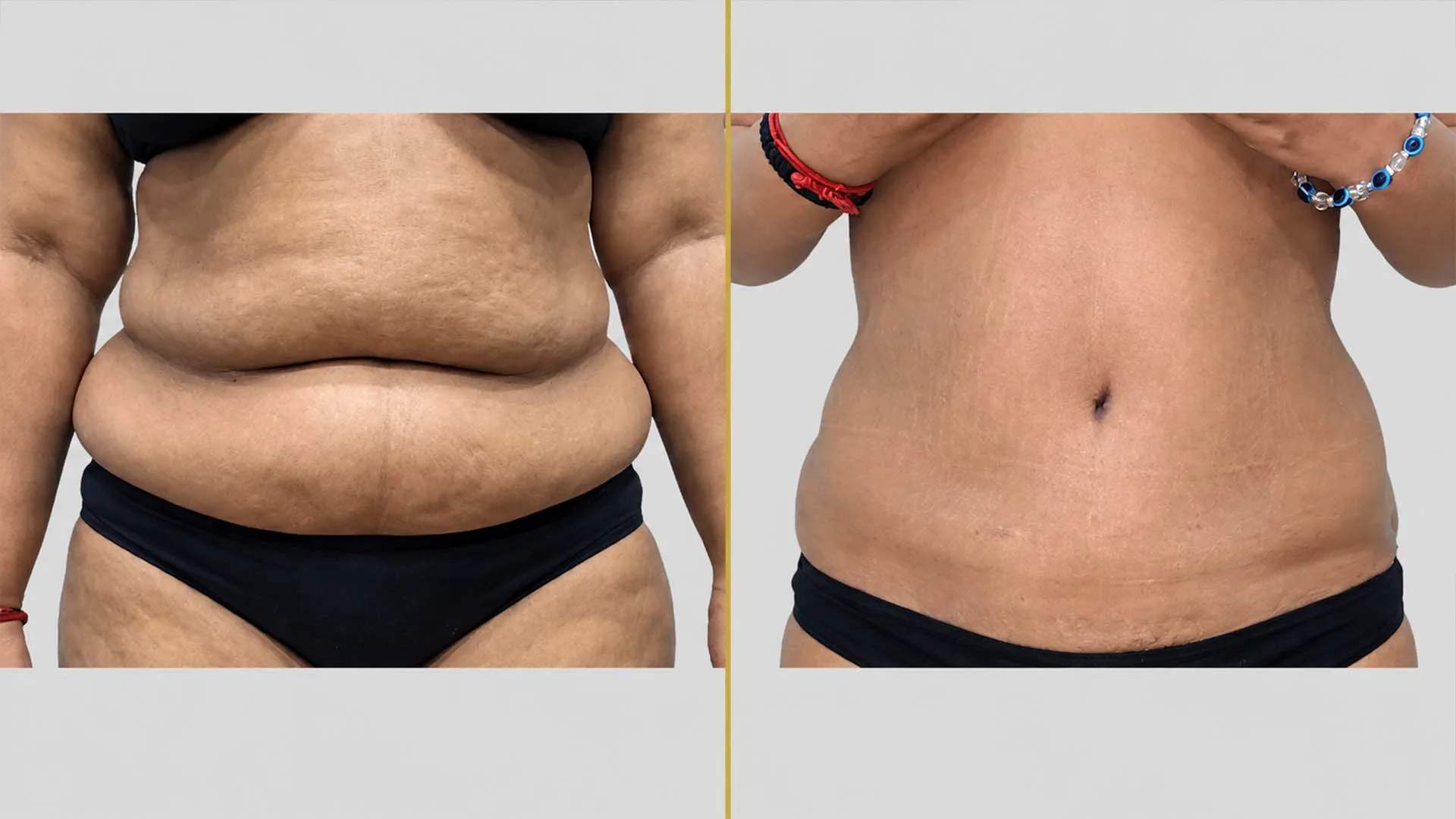 Tummy Tuck before and after result - The Hair and Shape Clinic, Mumbai