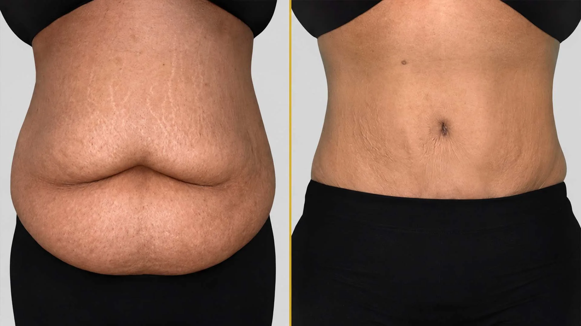 Tummy Tuck before and after result - The Hair and Shape Clinic, Mumbai