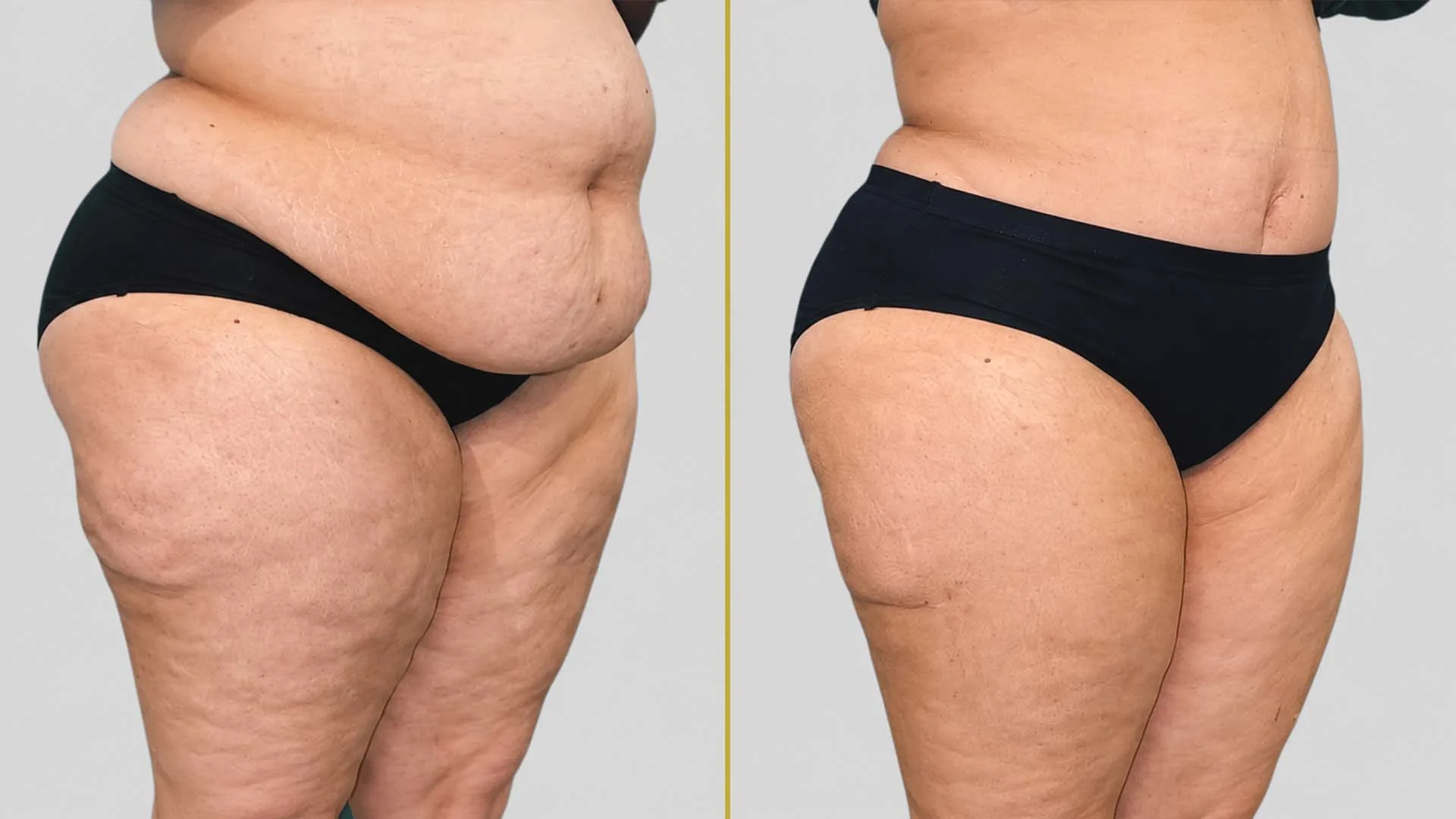 Tummy Tuck before and after result - The Hair and Shape Clinic, Mumbai