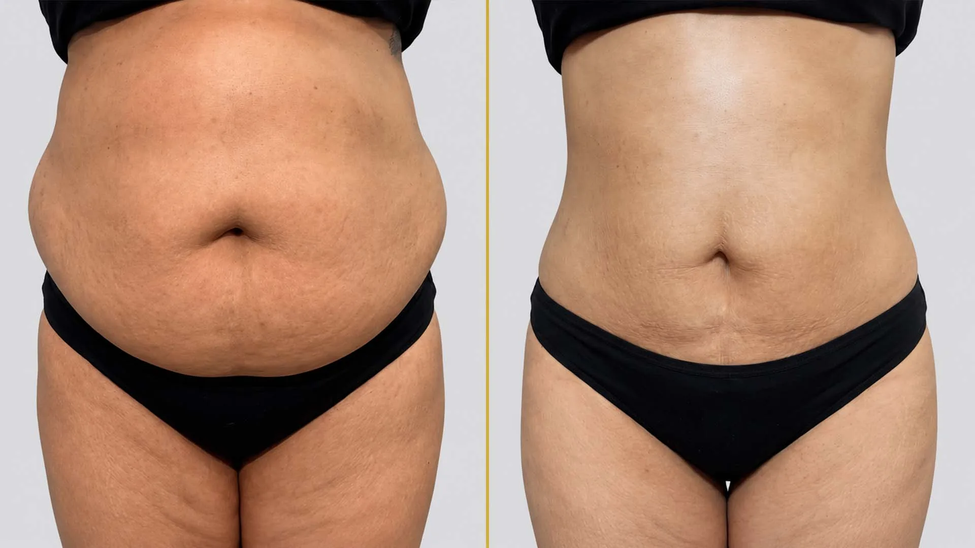 Tummy Tuck before and after result - The Hair and Shape Clinic, Mumbai