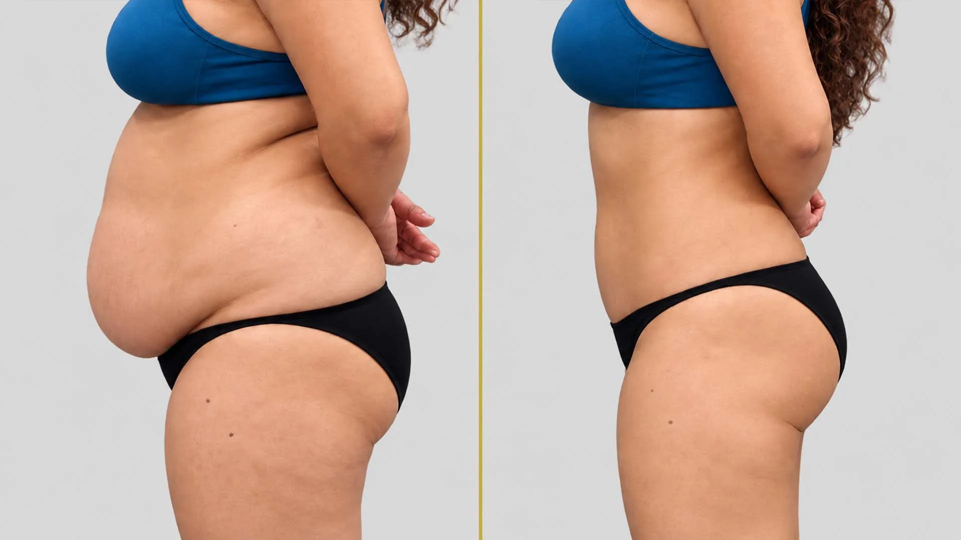 Tummy Tuck before and after result - The Hair and Shape Clinic, Mumbai