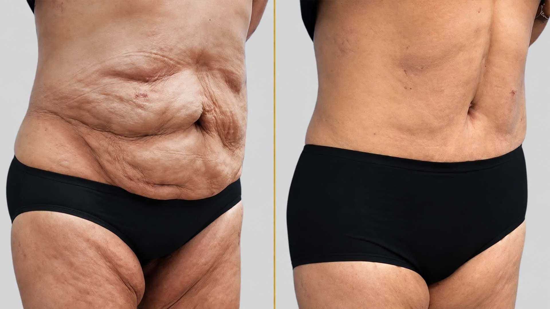 Tummy Tuck before and after result - The Hair and Shape Clinic, Mumbai