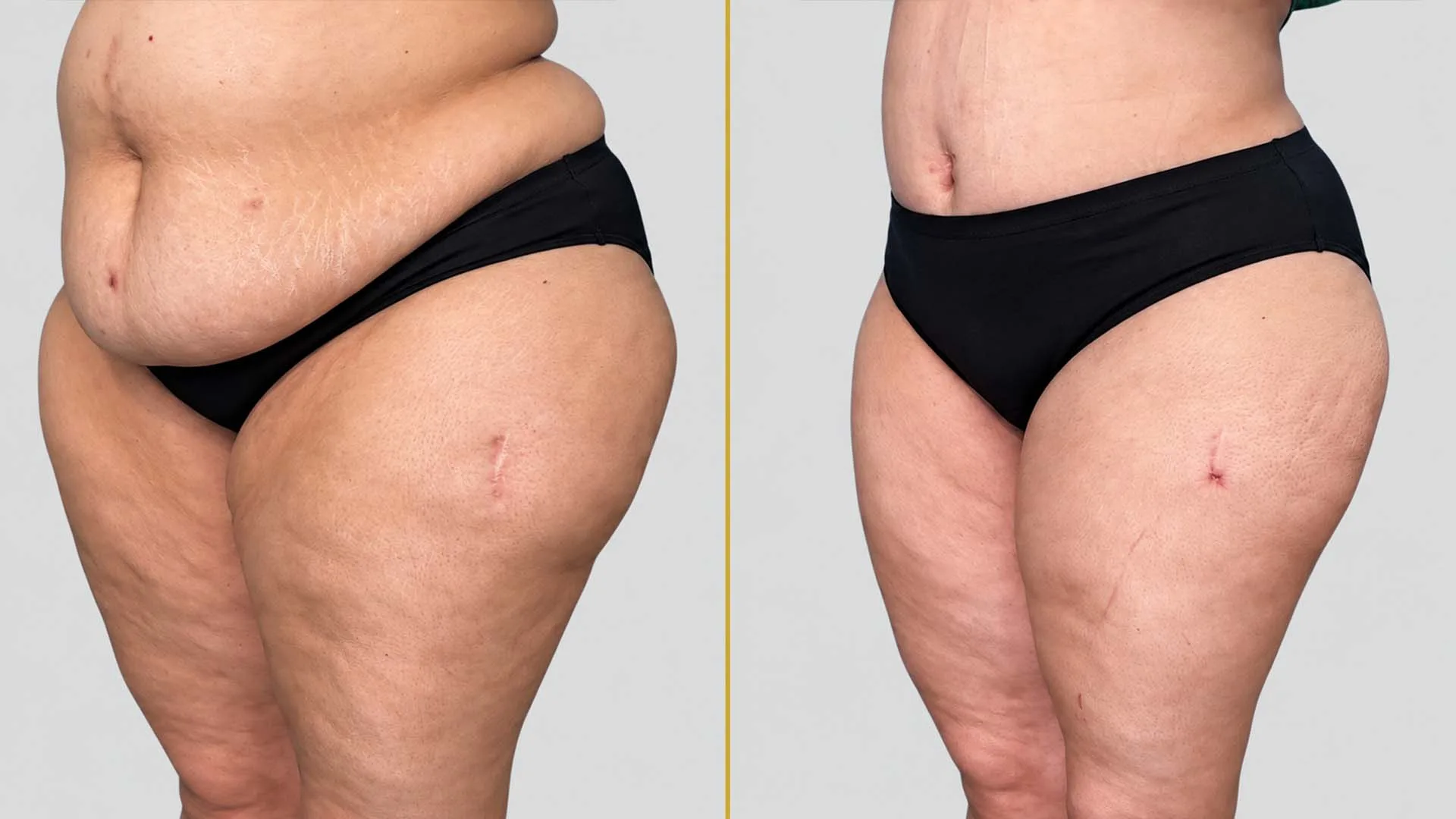 Tummy Tuck before and after result - The Hair and Shape Clinic, Mumbai