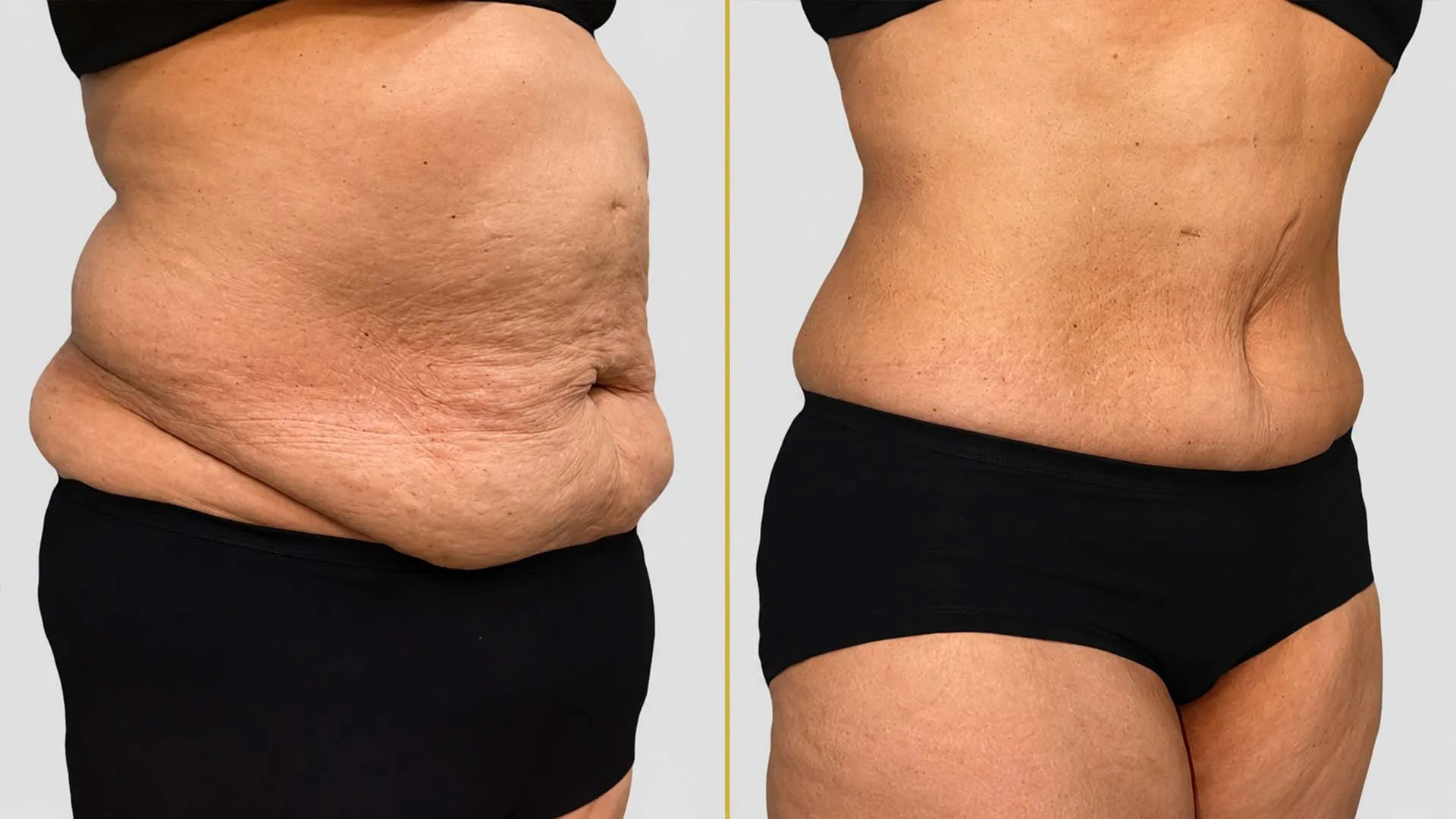 Tummy Tuck before and after result - The Hair and Shape Clinic, Mumbai