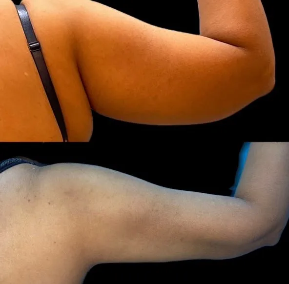 Vertical before and after clinical photos showing a female patient's upper arm fat reduction following laser-assisted arm liposuction at The Hair and Shape Clinic.