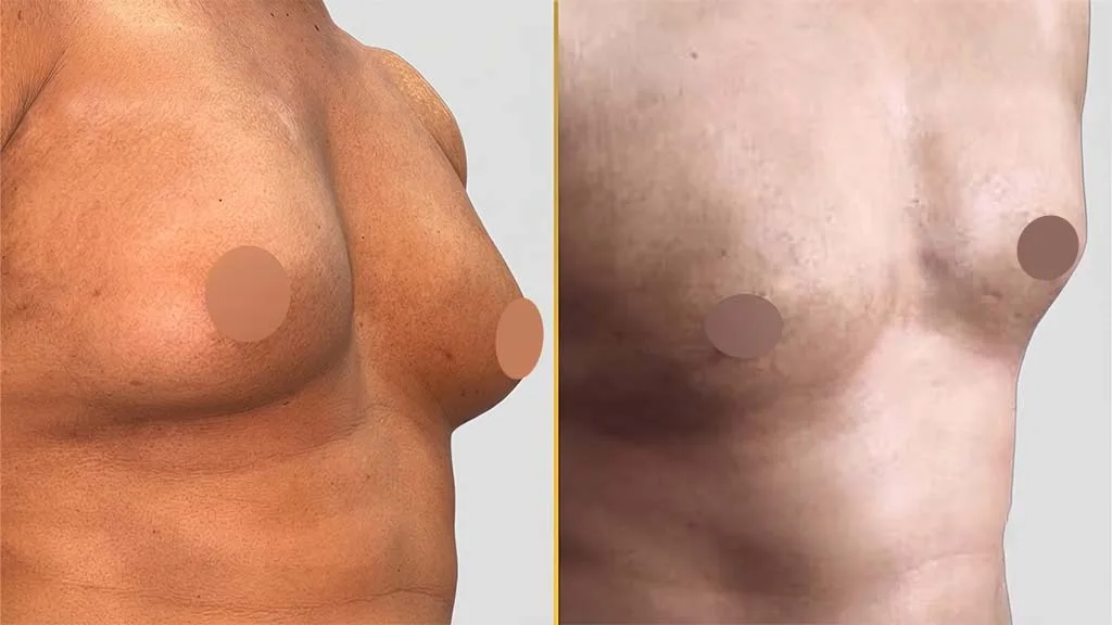 Before and after side profile comparison of a male patient successfully treated for gynecomastia with laser-assisted liposuction and gland removal by Dr. Umang Kothari.