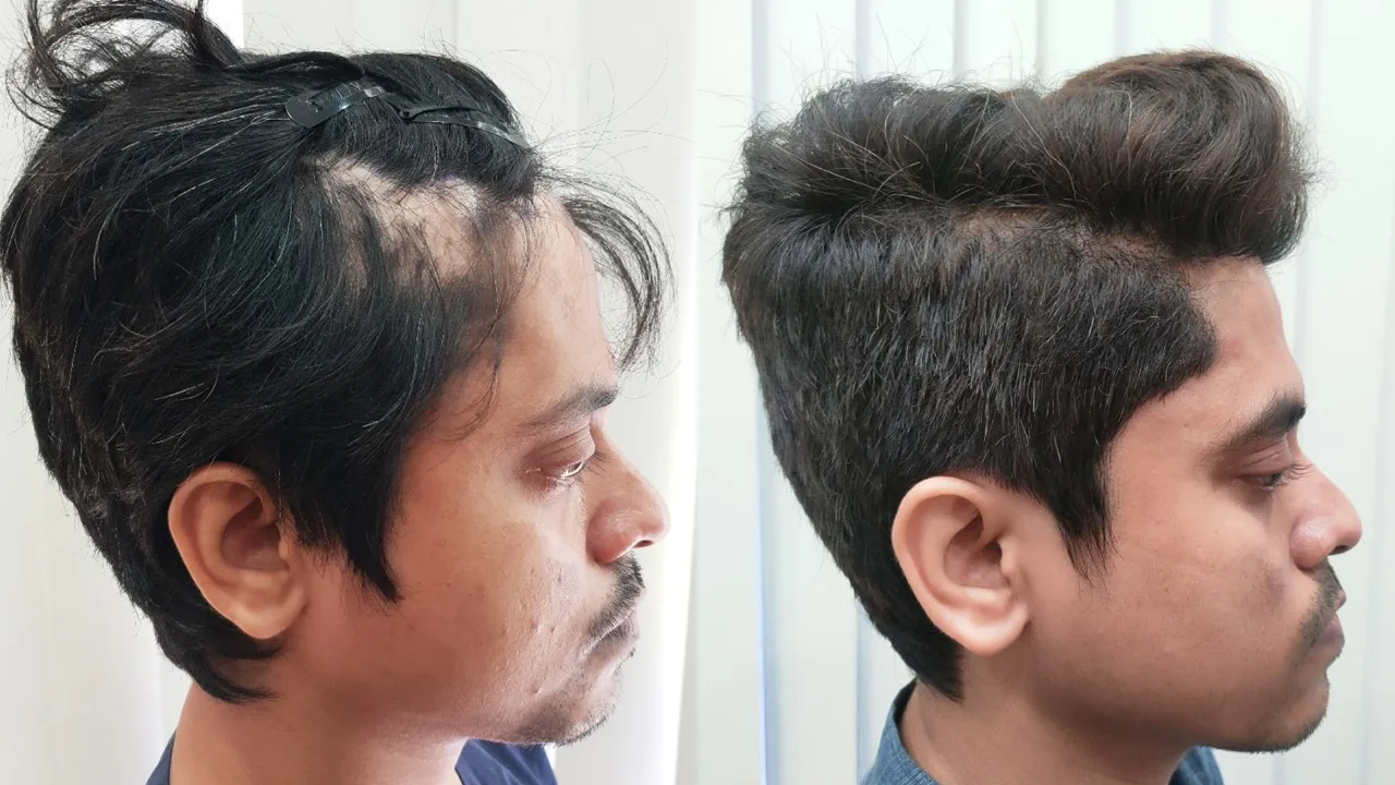 Before and after side profile comparison of male hairline restoration showing reconstructed temporal triangles and dense hair growth after a hair transplant in Mumbai.