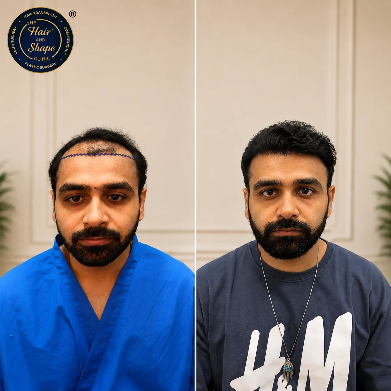 Before and after results of a 35-year-old male patient who achieved maximum density through a 5500-graft FUE hair transplant mega-session in Mumbai.