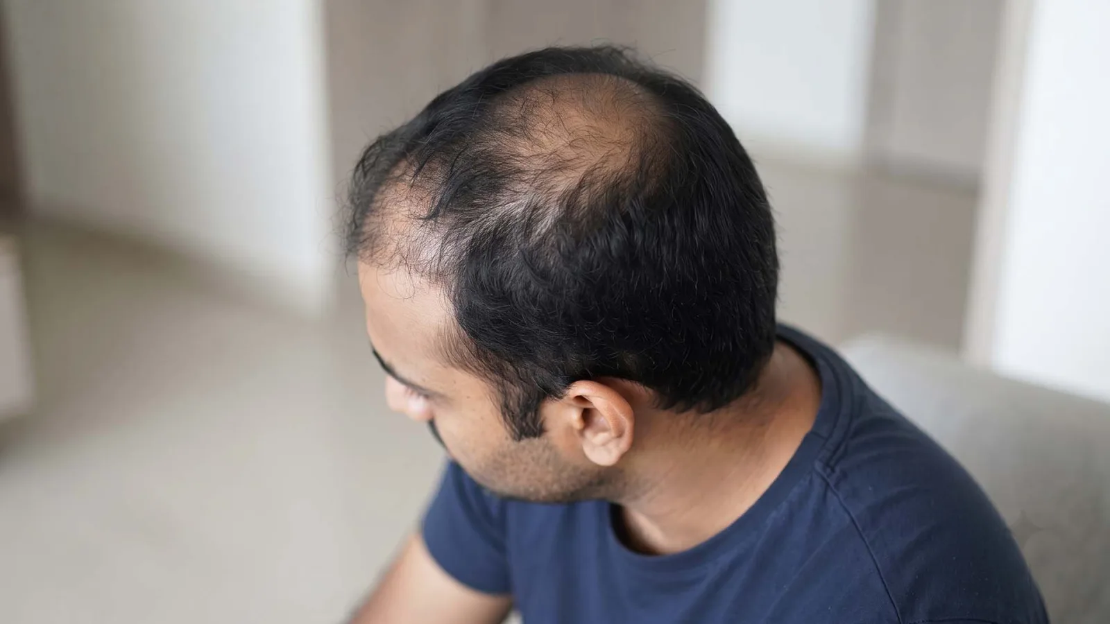 A satisfied patient in a clinical examination chair using a hand mirror to inspect his dense crown and natural hairline after a 4,500-graft hair transplant.